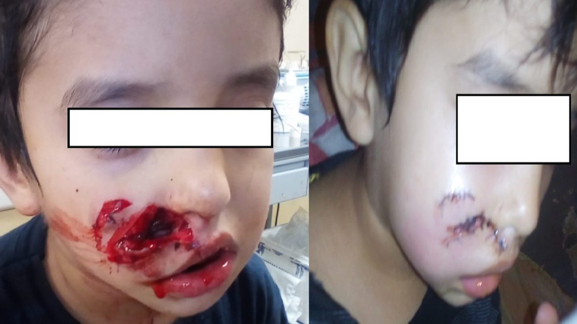 Perro suelto mordió a un niño pequeño en Río Grande Perro suelto mordió a un niño pequeño en Río Grande