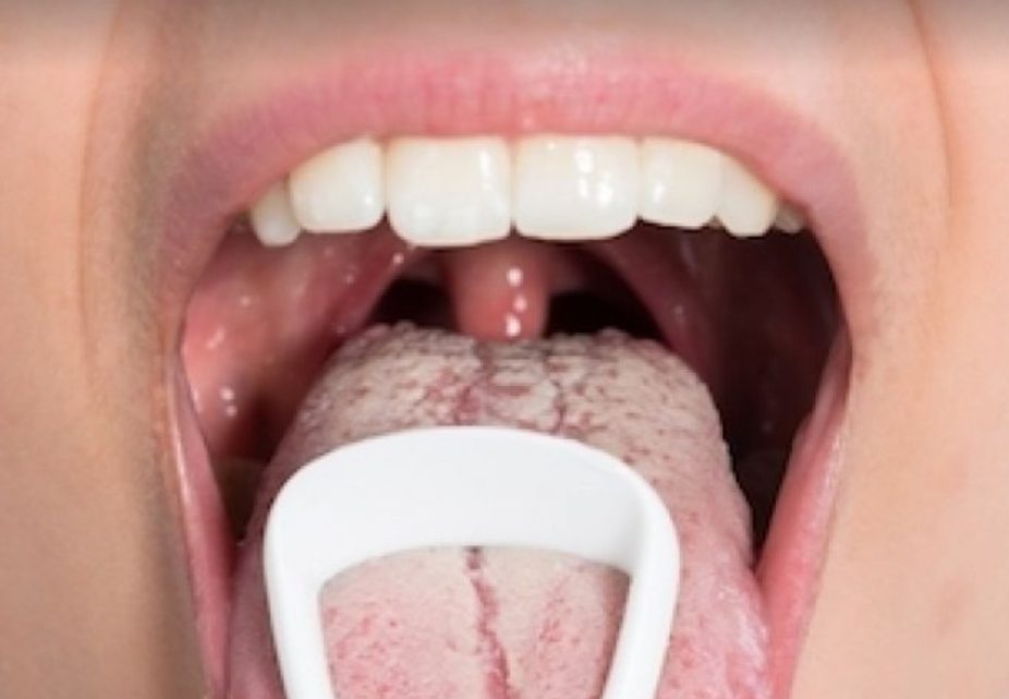 «Sapito», Le Enfermedad De Transmisión Sexual Que Te Deja La Lengua Blanca: ¿Cómo Se Contagia? «Sapito», Le Enfermedad De Transmisión Sexual Que Te Deja La Lengua Blanca: ¿Cómo Se Contagia?