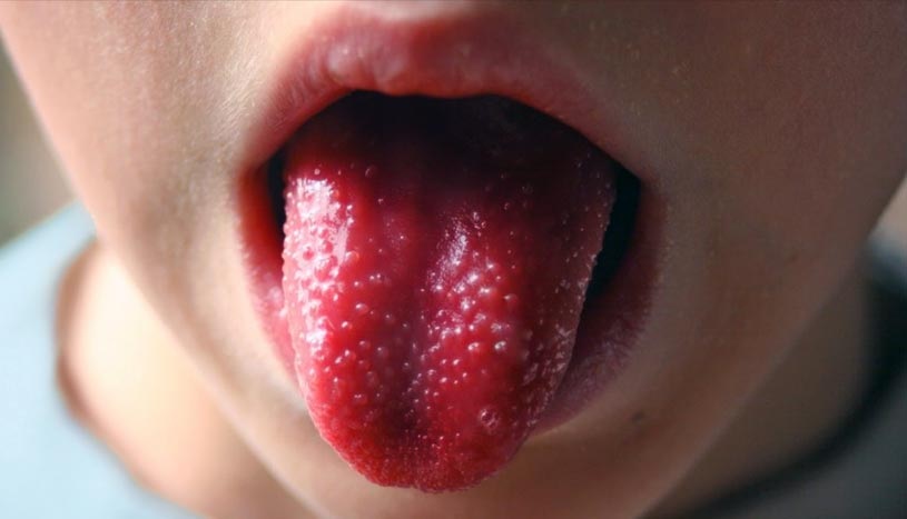 Coronavirus: EL MAL DE KAWASAKI EN LOS NIÑOS PODRIA SER UNA MUTACION DE LA ENFERMEDAD Coronavirus: EL MAL DE KAWASAKI EN LOS NIÑOS PODRIA SER UNA MUTACION DE LA ENFERMEDAD