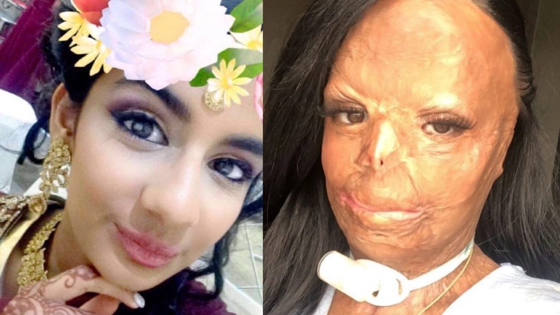Sufrió quemaduras en el 55% de su cuerpo y asegura que ahora es mejor persona: “Soy mucho más fuerte” Sufrió quemaduras en el 55% de su cuerpo y asegura que ahora es mejor persona: “Soy mucho más fuerte”