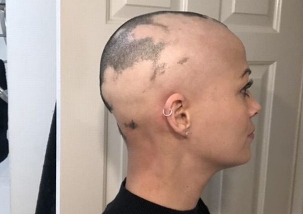 Perdió todo su pelo después de usar una bobina anticonceptiva Perdió todo su pelo después de usar una bobina anticonceptiva