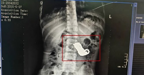 Un nene se comió más de 100 bolitas magnéticas mientras miraba televisión Un nene se comió más de 100 bolitas magnéticas mientras miraba televisión