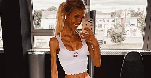 Murió la influencer de 24 años que mostraba su lucha contra la anorexia Murió la influencer de 24 años que mostraba su lucha contra la anorexia
