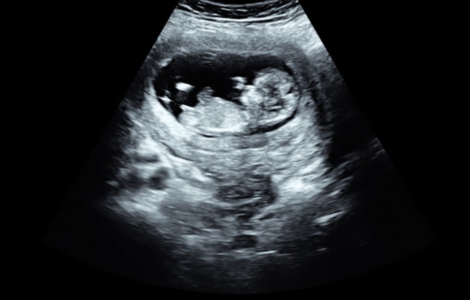 Piden que las mujeres vean una ecografía del bebé antes de hacerse un aborto Piden que las mujeres vean una ecografía del bebé antes de hacerse un aborto