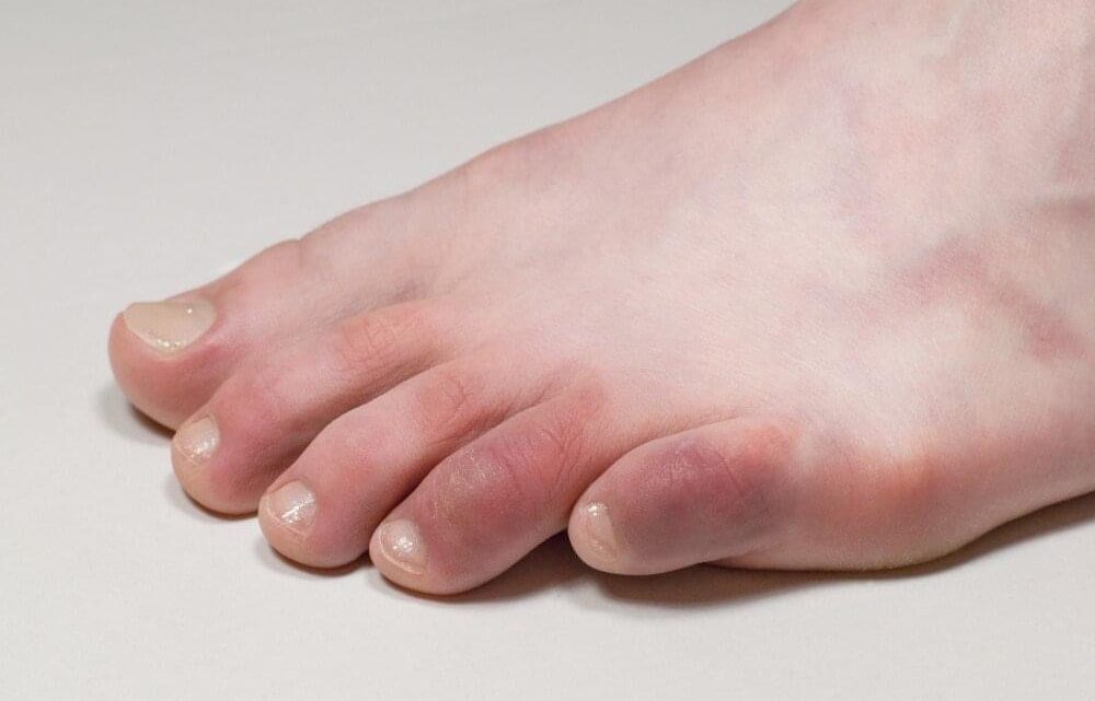 Fue Al Médico Por Un Dolor En Un Dedo Del Pie Y Le Dieron «Cuatro Días De Vida» Fue Al Médico Por Un Dolor En Un Dedo Del Pie Y Le Dieron «Cuatro Días De Vida»